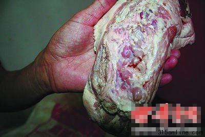 甲狀腺未摘除干凈的“雨潤(rùn)問(wèn)題肉” 甲狀腺未摘除干凈的“雨潤(rùn)問(wèn)題肉”